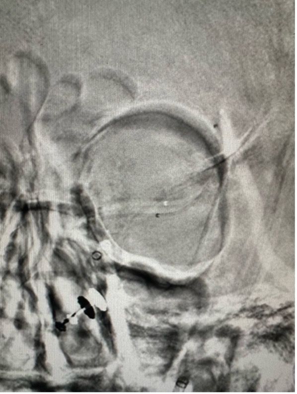 Gravity Supernova device research