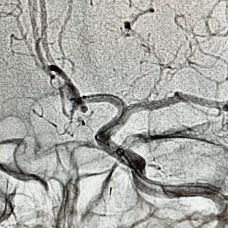 Angiogram after treatment, magnified on the sealed aneurysm