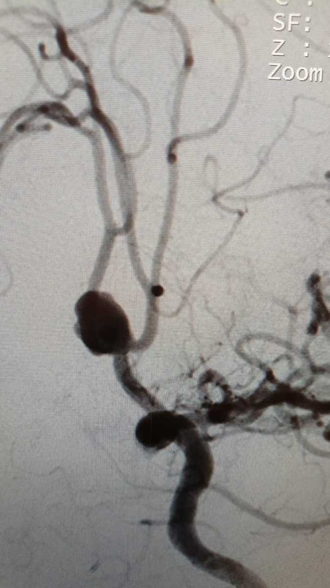 Angiogram showing the ruptured brain aneurysm before treatment