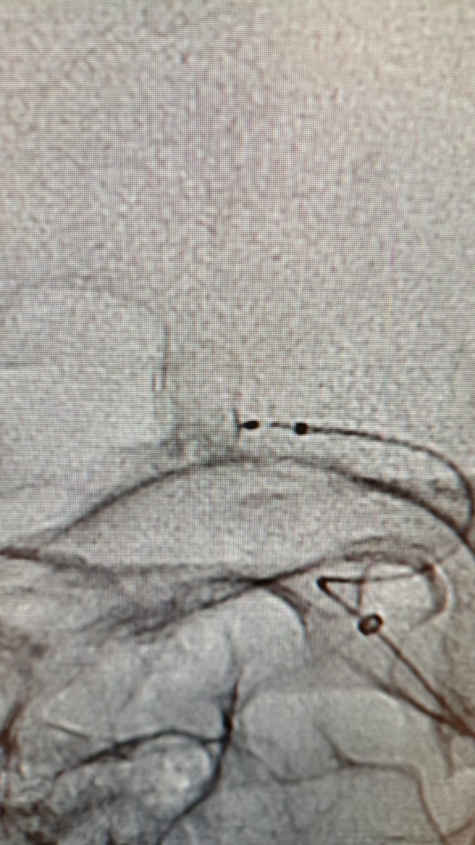 The SEAL device inside the aneurysm