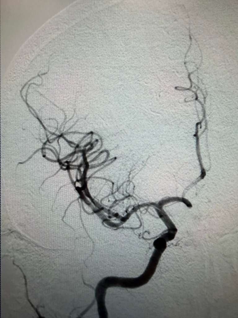 Cerebral angiogram before treatment: the right middle cerebral artery is blocked by a clot