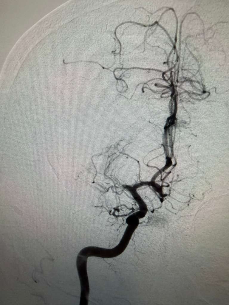 Cerebral angiogram after clot retrieval: full blood flow restored